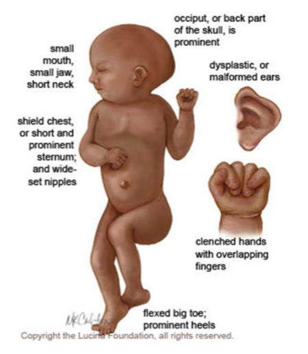 <p>47,XX +18, 1 in 3000, multiple malformations (Heart, kidney in particular), clenched hands with overlapping fingers, 90% mortalitity before 5 months</p>