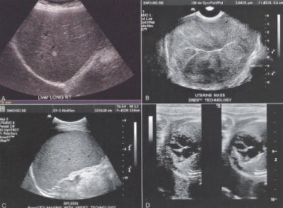 <ul><li><p><span style="background-color: transparent;">The granular appearance of images that is caused by the interference of echoes from the distribution of scatterers in tissue.</span></p></li><li><p><span style="background-color: transparent;">The generation of this artifact can be compared to throwing a handful of marbles into a pond. Each marble generates a circular propagating wave. These waves combine together through the effects of constructive and destructive interferences.</span></p></li><li><p><span style="background-color: transparent;">The location of the highest wave does not necessarily represent the location where the marble impacted the water, but rather where the marble waves come together to form a larger wave.</span></p></li><li><p><span style="background-color: transparent;">Reduced by using:</span></p><ul><li><p><span style="background-color: transparent;">Spatial compounding</span></p></li><li><p><span style="background-color: transparent;">Persistence</span></p></li></ul></li></ul><p></p>