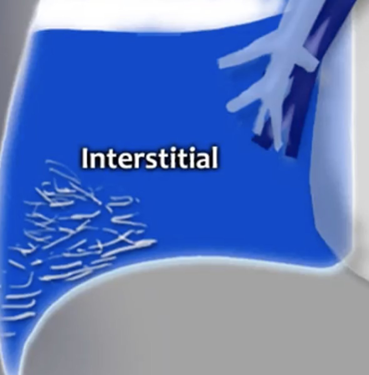 <p>reticular pattern is thickening of interstitial fiber network by fluid, fibrous tissue, or infiltration</p>