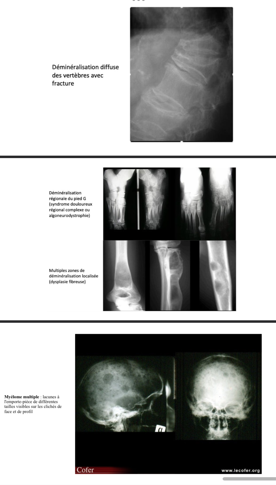 <p>= diminution de la densité osseuse </p><p>→ diffuse : ostéoporose, hyper parathyroïdie</p><p>→ localisée : tumeurs, ostéite, algoneurodystrophine </p><p>→ enaires multiples : méta, myélome, dysplasie fibreuse  </p><p></p>