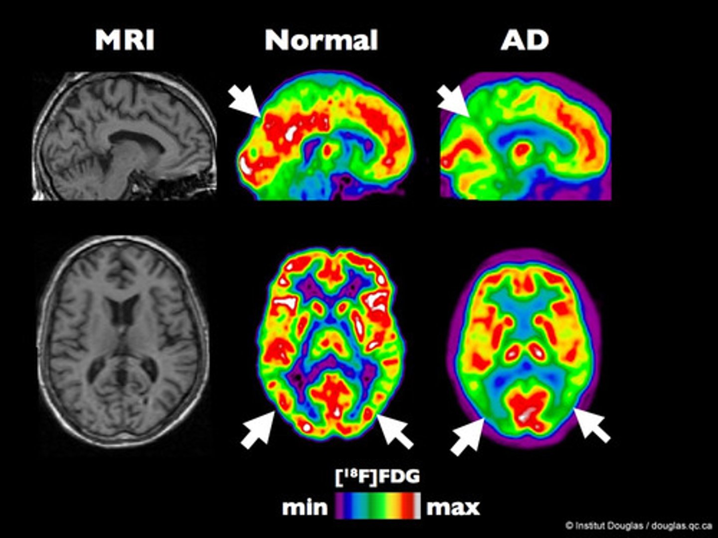 <p>A visual display of brain activity that detects where a radioactive form of glucose goes while the brain performs a given task.</p>