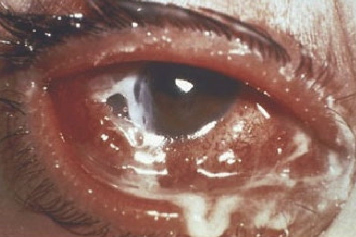 <ul><li><p>Lid edema</p></li><li><p>Chemosis</p></li><li><p>Papillary conjuctival reaction </p></li><li><p>Corneal involvement: Infiltrate, ulceration, and perforation</p><ul><li><p><strong>Can invade an intact corneal epithelium</strong></p></li></ul></li><li><p>Very stinky, smells awful&nbsp;</p></li></ul><p></p>