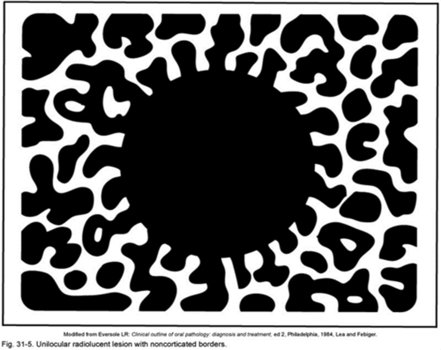 <p>No well-defined outline around a radiolucent lesion</p>