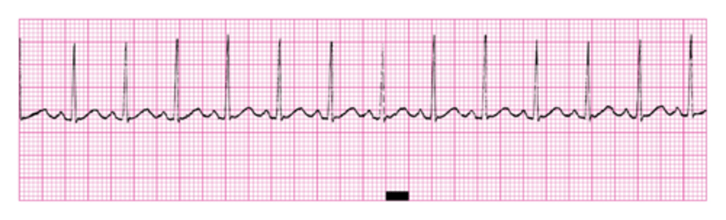 <p>Count the # of little blocks between QRS complexes and divide into 1500.</p><p>Ex. 1500/11= 136</p>