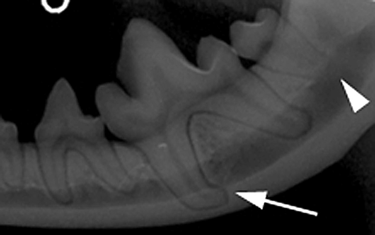 A sharp bend or curve in the root or crown of a tooth.