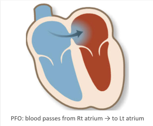 <p>a hole between the left and right atria (upper chambers) of the heart<span>. This hole exists in everyone before birth, but most often closes shortly after being born. PFO is what the hole is called when it fails to close naturally after a baby is born.</span></p>
