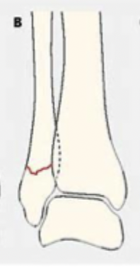 <p>Describe a Weber B</p>