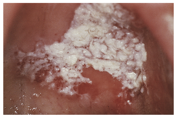 <p>10. A 49-year-old man has used chewing tobacco and snuff</p><p>for many years. On physical examination the lesion shown in</p><p>the figure is seen on the hard palate. It cannot be removed by</p><p>scraping. A biopsy is performed, and microscopic examination</p><p>of the lesion shows a thickened squamous mucosa. Four years</p><p>later, a biopsy specimen of a similar lesion shows carcinoma in</p><p>situ. Which of the following is the most likely diagnosis?</p><p>A Oral thrush</p><p>B Lichen planus</p><p>C Leukoplakia</p><p>D Pyogenic granuloma</p><p>E Xerostomia</p>
