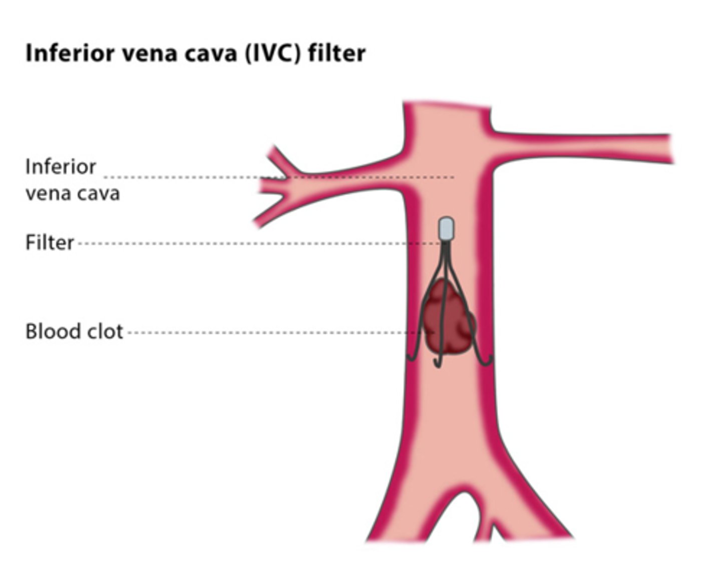 <p>deep vein thrombosis is a potentially fatal condition where a clot (thrombus) is formed in the deep venous system of the legs and the veins of the pelvis</p><p>predispositions: hospitalization, surgery, oral contraceptives, smoking, air travel, clotting abnormalities (e.g., protein S and protein C deficiencies) </p><p>• inferior vena cava filter is placed to trap any large clots and removed after the risk period has ended if it is not possible to treat pt with prophylactic treatment </p>