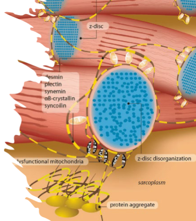 <p><span style="font-size: calc(var(--scale-factor)*27.96px)">Pattern of muscle weakness in desmin-related muscle disorders</span><span><br></span><span style="font-size: calc(var(--scale-factor)*27.96px)">Lower limb muscle weakness slowly spreading to involve truncal, neck- flexor, facial and bulbar</span></p>