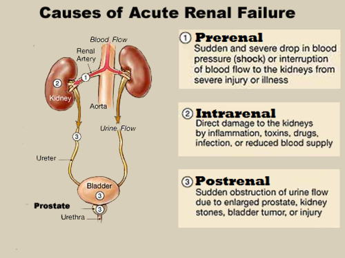 -*most common AKI*
-renal hypoperfusion with intact parenchyma- caused by impaired renal blood flow- normal compensatory mechanism is release of ATII --> afferent arteriole vasodilation and constriction of efferent arterioles to maintain GFR but this will fail if prolonged
•Hypovolemia: hemorrhage, GI fluid loss, renal fluid loss, extravascular sequestration (burns, pancreatitis, renal artery stenosis, severe hyperalbuminemia), decreased intake
•Low cardiac output
•systemic vasodilation: sepsis, anti hypertensives, anaphylaxis
•renal vasoconstriction: hypercalcemia, catecholamines, amphotericin B
•Impairment of renal autoregulatory responses: NSAIDS, ACEI, ARBs