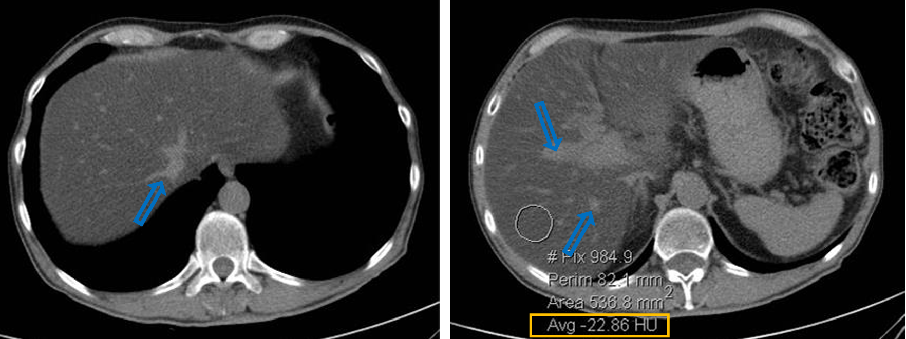<p>Patient history : elevated ALT (alanine transaminase) in a patient with hyperlipidemia </p><p>Modality: noncontrast CT </p><p>Region: upper abdomen, axial views</p><p>Radiologic sign: Diffusely, homogenously decreased density (cca. - 20 HU) of the liver (hepatic density normally is around 50-60 HU). The vessels (blue arrow) are denser in comparison to the liver parenchyma. </p><p>Diagnosis: steatosis hepatis (fatty liver)</p>