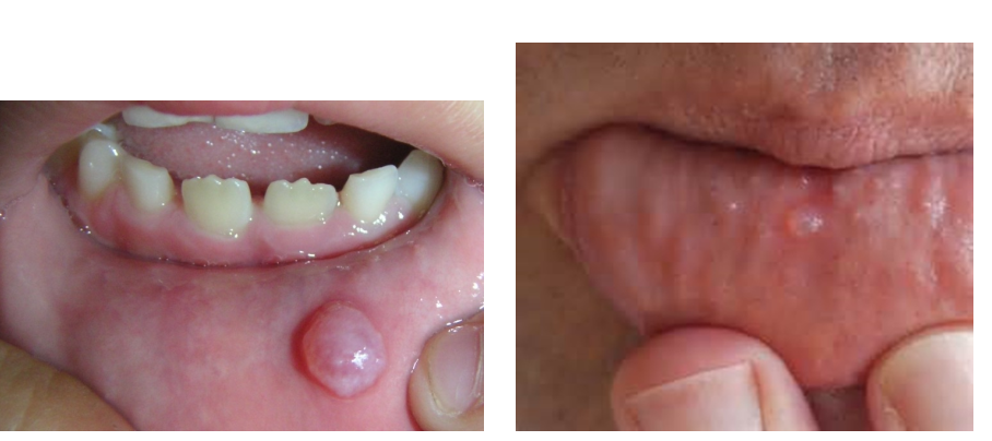<p>Accumulation of saliva in the mucosa due to trauma to a<strong> minor salivary duct</strong></p><p><em>*mucoepidermoid carcinoma kinda looks like a mucocele</em><strong> </strong><em>but its more commonly located by/at/in the parotid salivary gland  </em></p>