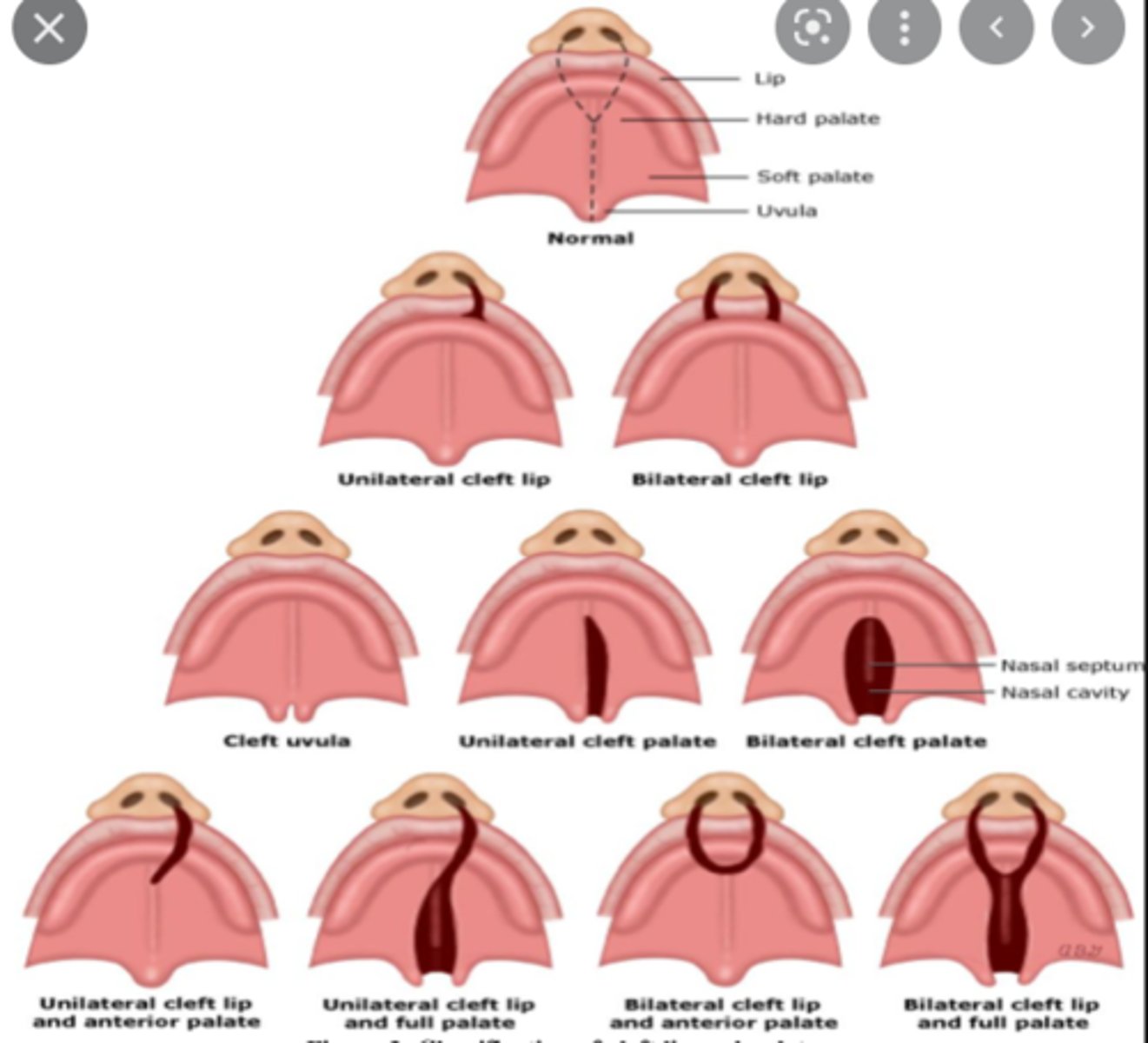 <p>Oral clefts result from the disruption of what? (2)</p>