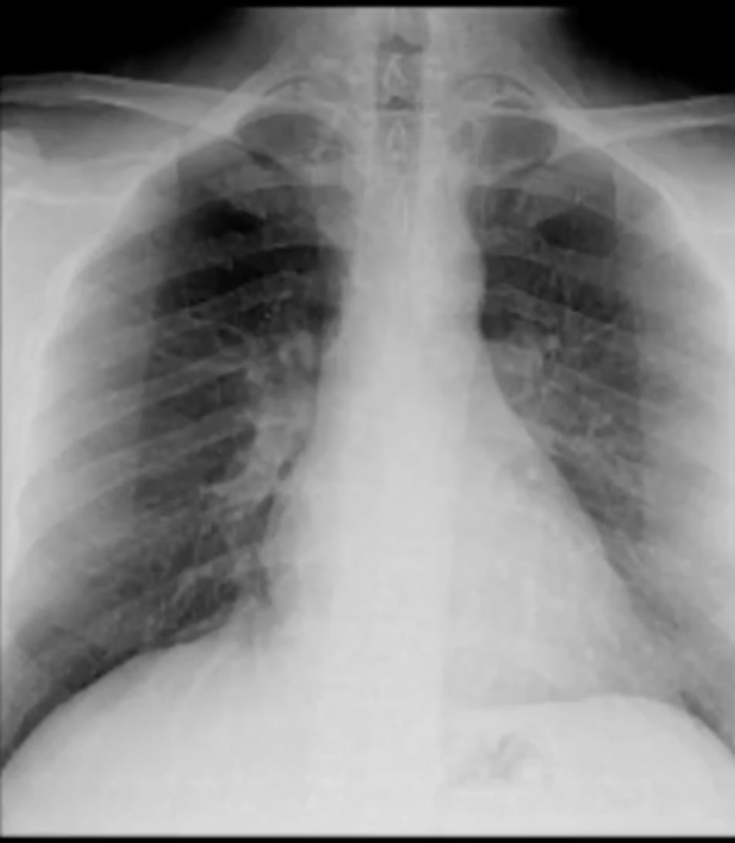 <p>CXR done when pt cannot stand up; makes heart appear large so cannot evaluate cardiomegaly</p>