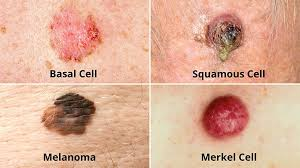 <ul><li><p><span>Some basal cell carcinomas may appear as raised, pink or red, translucent, shiny, pearly bumps that may bleed after a minor injury. They may have a lower area in their center, and blue, brown, or black areas.</span></p></li><li><p><span>Types include basal cell cancers, melanomas, squamous cell carcinomas</span></p></li></ul>