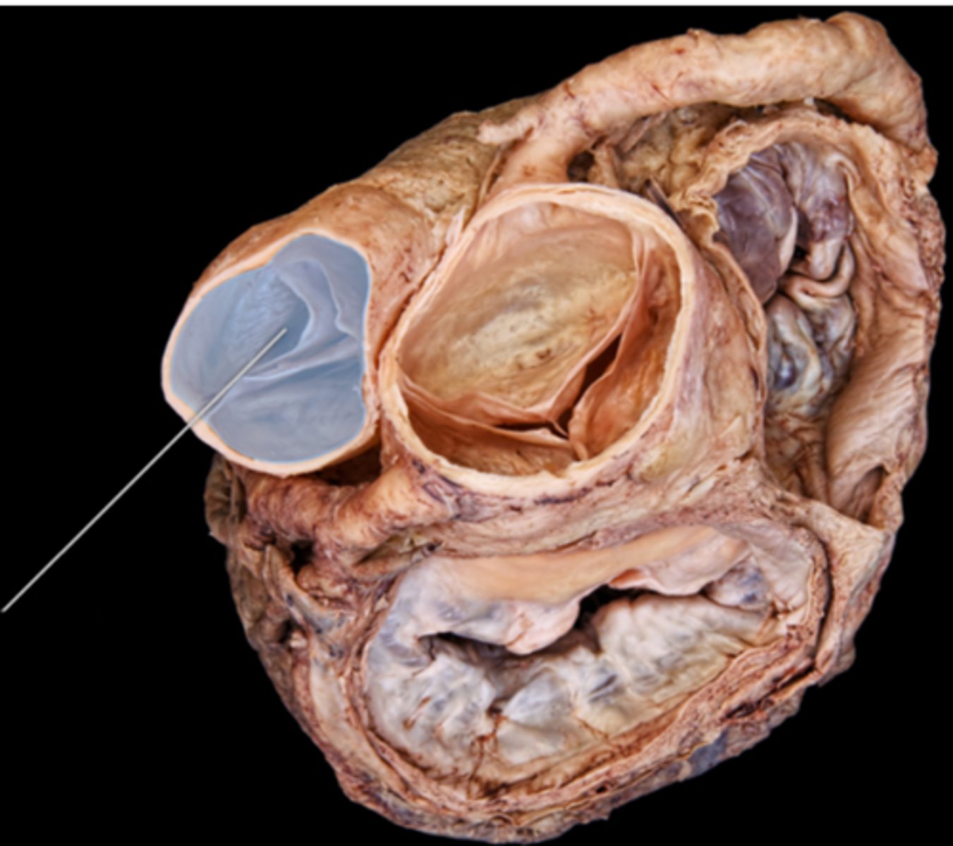 <p>pulmonary semilunar valve</p>