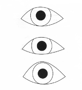 <p>IMPORTANT: if there is a a narrow palpebral fissure, how should you fit the lens? (middle picture)</p>