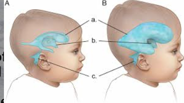 <p>“water on the brain” </p><ul><li><p>accumulation of CSF caused by an imbalance in production and drainage of fluid </p></li><li><p>symptom: large head </p></li></ul><p></p>
