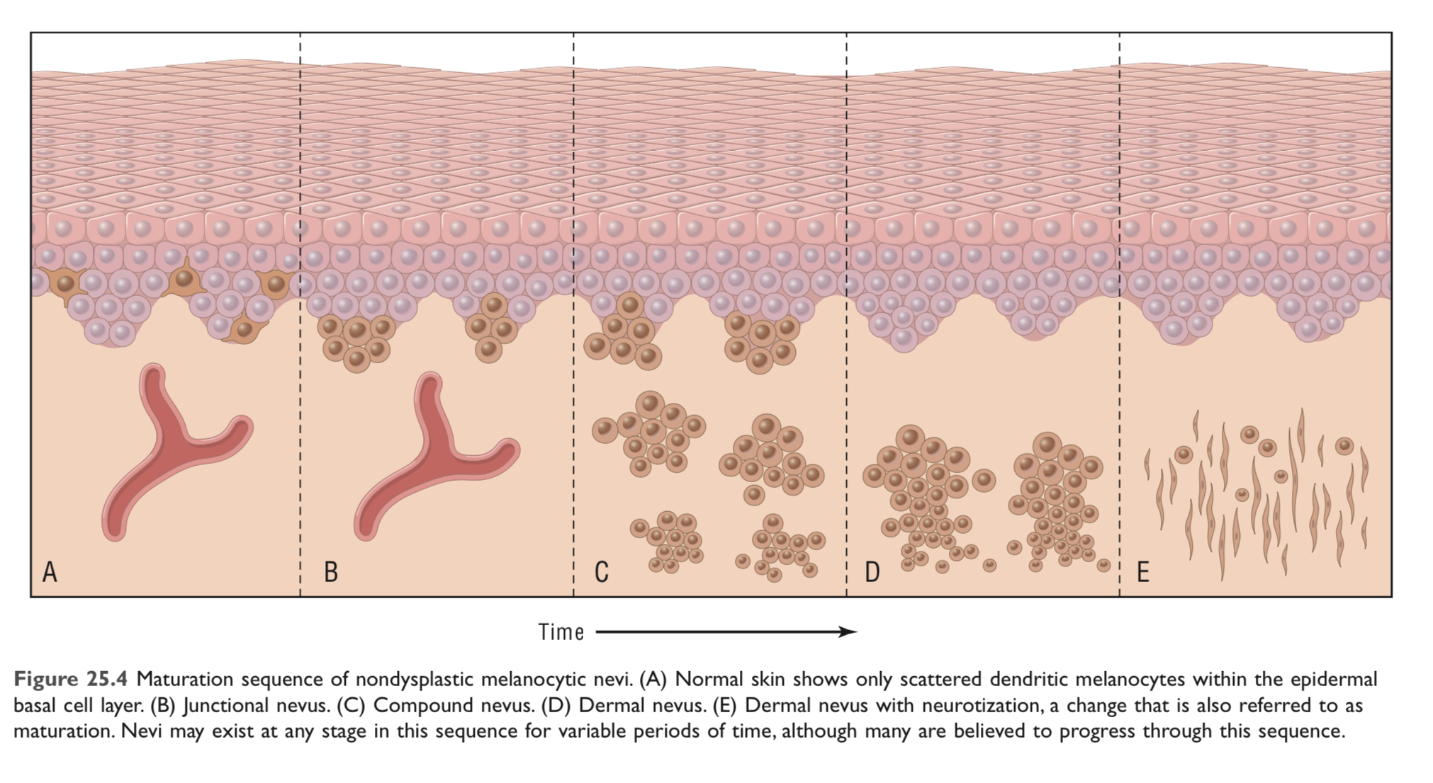 * common benign neoplasms (non dysplastic)
* usually caused by acquired mutations in components of the RAS signalling pathway (eg. activation of RAS or BRAF)
* they rarely give rise to melanomas, may be due to oncogene induced senescence (+ RAS/BRAF → accumulation of p16/INK4a → growth arrest)
* uniformly pigmented, small, relatively flat
* may become more prominent during pregnancy → some level of hormone sensitivity
* thought to progress through a series of morphologic changes over time

  
  1. junctional nevi: aggregated or nests of round cells that grow along the dermoepidermal junction

     nevus cells are uniform and rounded, contain small nuclei and show little to no mitotic activity
  2. compound nevi: ^ grow into the underlying dermis
  3. intradermal nevi: epidermal nests are lost, melanocytes acquire fusiform contours and grow in fascicles resembling neural tissue (= neurotisation) → figure E
* 2 and 3 are usually more elevated than junctional nevi