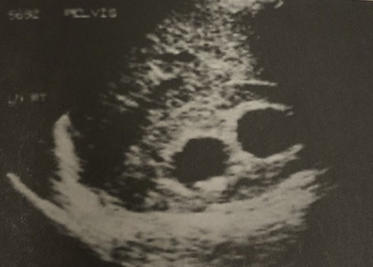 <p>633. This patient presents in her mid second trimester with right flank pain. Her obstetric sonogram is normal so the doctor orders an ultrasound exam of her right upper quadrant. The longitudinal scan below demonstrates:</p><p>A. Hydronephrosis</p><p>B. Cholecystitis</p><p>C. Gallstones</p><p>D. Pyelonephritis</p><p>E. Liver enlargement</p>
