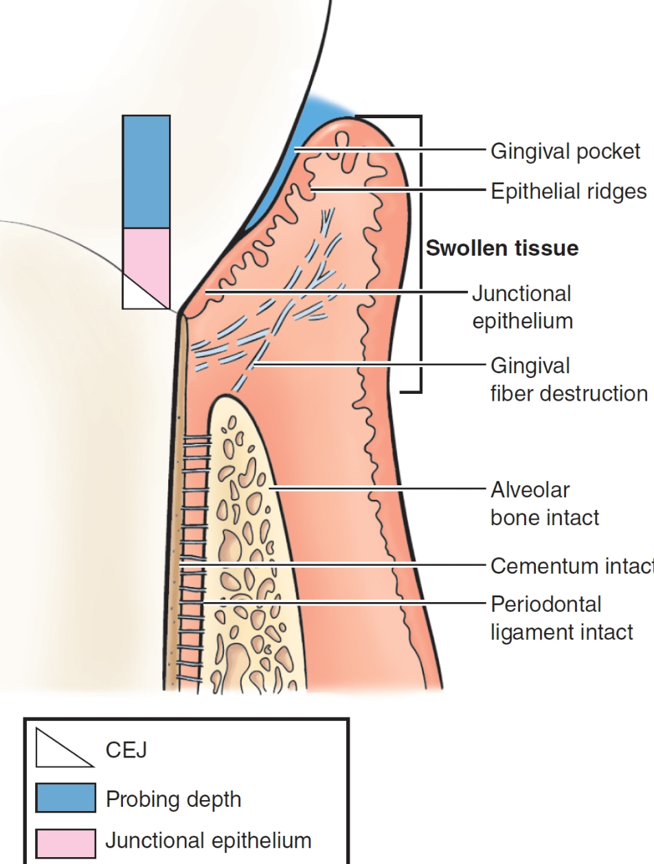 <p>some reversible tissue damage</p><p>clinical: red, swollen (edematous), bleeding likely, sulcus depth 3mm+</p><p>histological: JE at CEJ, supra-gingival fiber destruction, alveolar bone intact, periodontal ligament intact</p>
