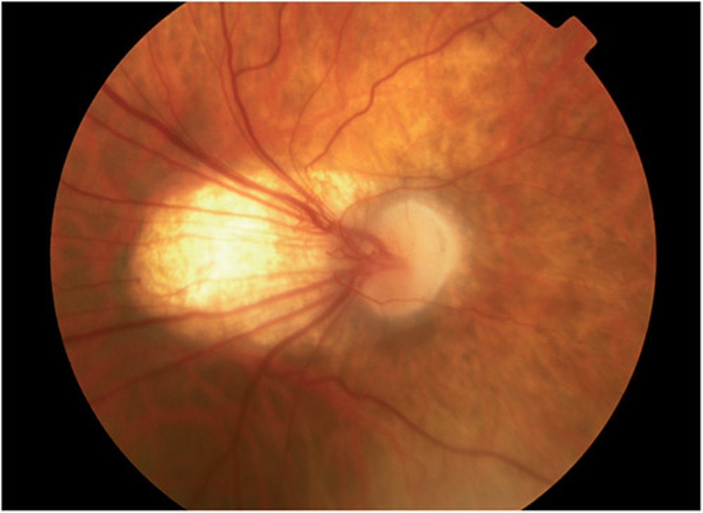 <p>- Incomplete vascularized premature retina</p><p>← initial injury to developing retinal vessels &amp; ↓ insulin-like growth factor 1</p><p>- Highest incidence infants of the lowest gestation age</p><p>- Can be controlled by regulation of the baby's O2 saturation level</p><p>Ophthalmoscopy</p><p>- ridge of fibrovascular proliferation</p><p>- abnormal blood vessels</p><p>- fibrous tissue</p>
