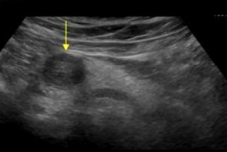 <p>Adenocarcinoma</p>