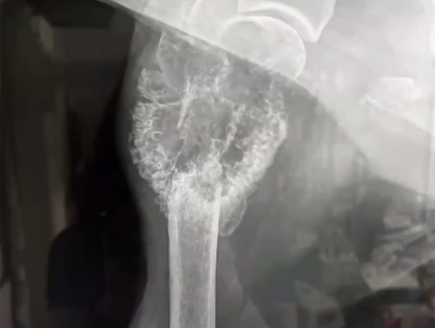 <ul><li><p>Radiograph the shoulder and thorax </p></li><li><p>Top differential is  a Sarcoma </p></li></ul><p></p>