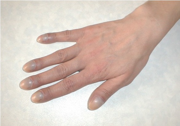 <p>angle bt nail base and finger is &gt; 180 degrees (lovibond’s sign); end of finger becomes rounded and bulbous</p><p>ex: chronic hypoxia</p>