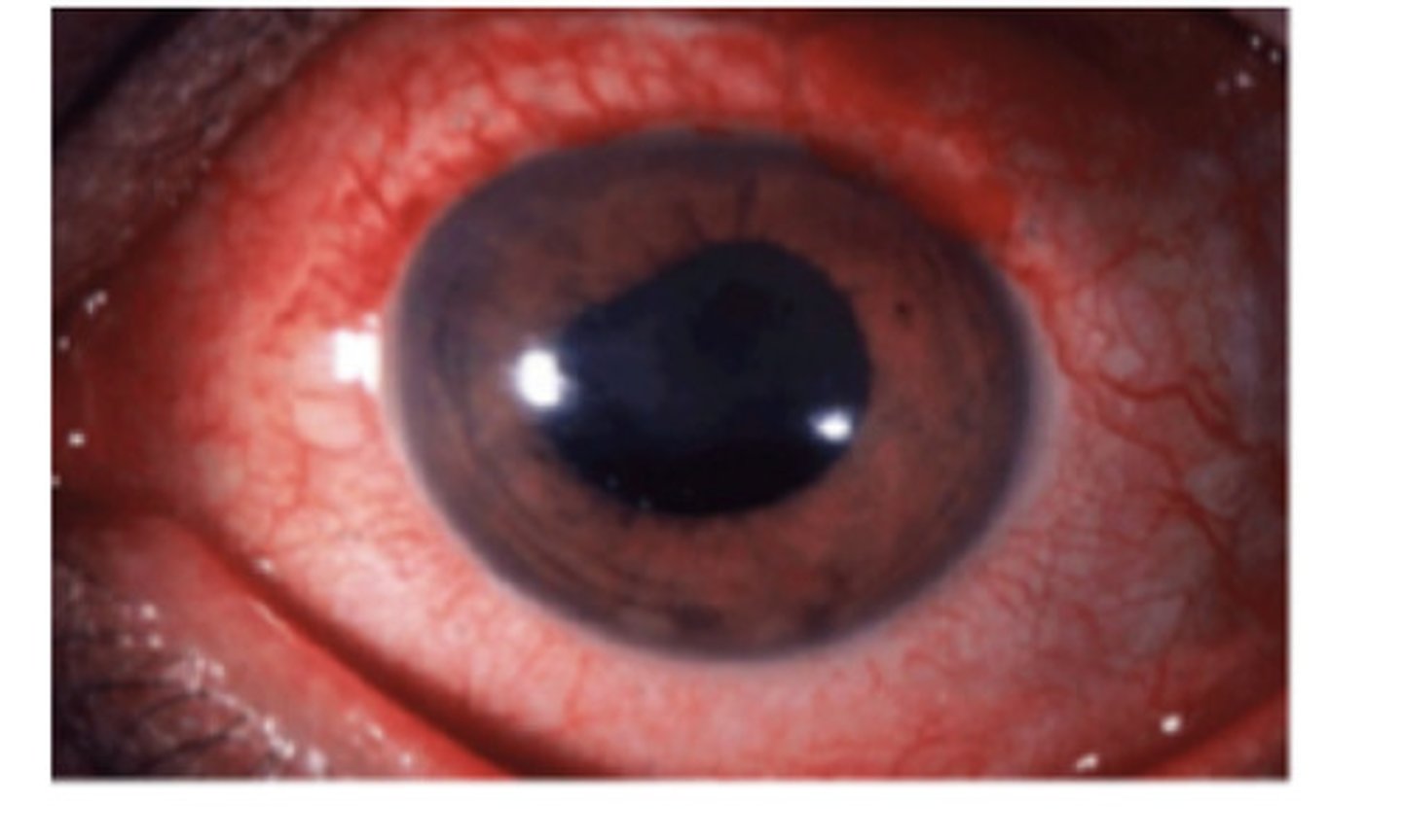 <p>What can cause Infectious Uveitis?</p>