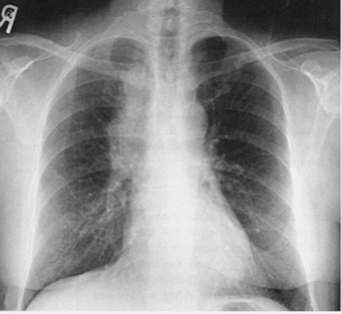 <p>What is the most frequent cause of a middle mediastinal mass? What finding on this x-ray would indicate this dz?</p>