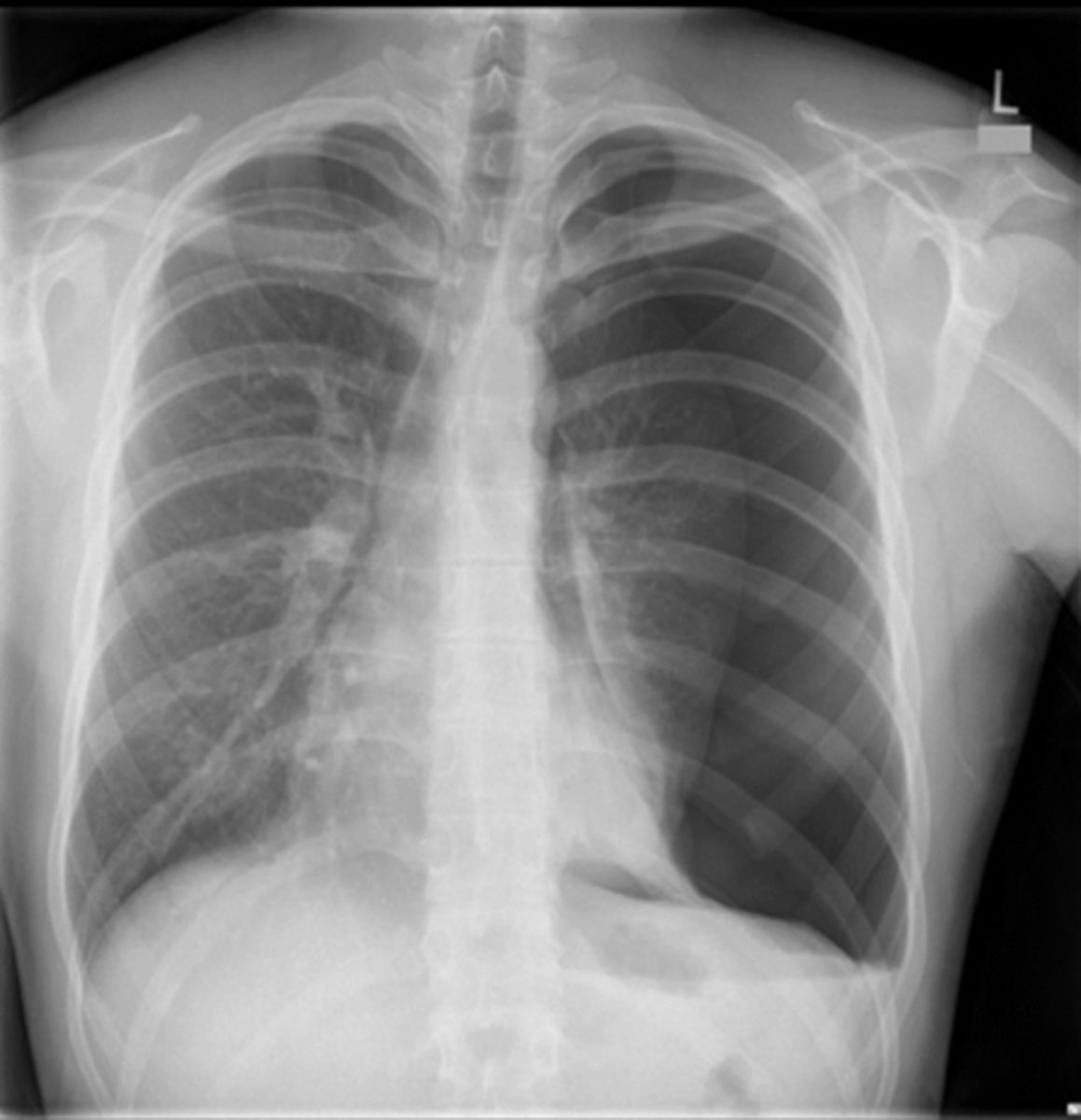 <p>Analyze this XR. What line do you see here and what is missing? What is the diagnosis?</p>