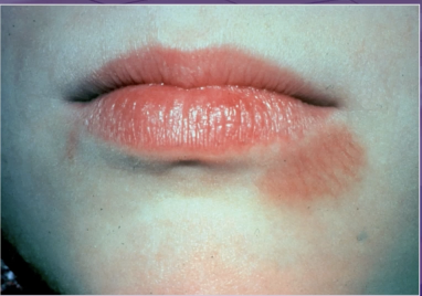 <p>what is the cause of this lesion</p><p>primary herpes </p><p>herpangina </p><p>licking lower lip </p><p>erythema multiforme </p>