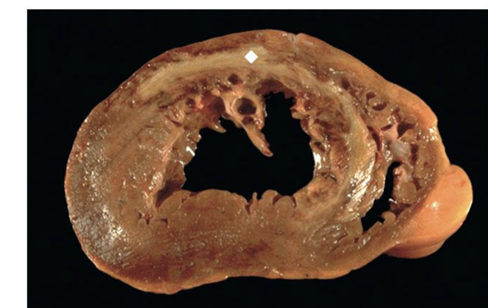 <ul><li><p>troponin (best marker)</p></li><li><p>occlusion of coronary artery</p></li></ul><p></p><p>complications:</p><ul><li><p>ventricular rupture</p></li><li><p>ventricular aneurysm</p></li><li><p>endocardial mural thrombus</p></li></ul><p></p>