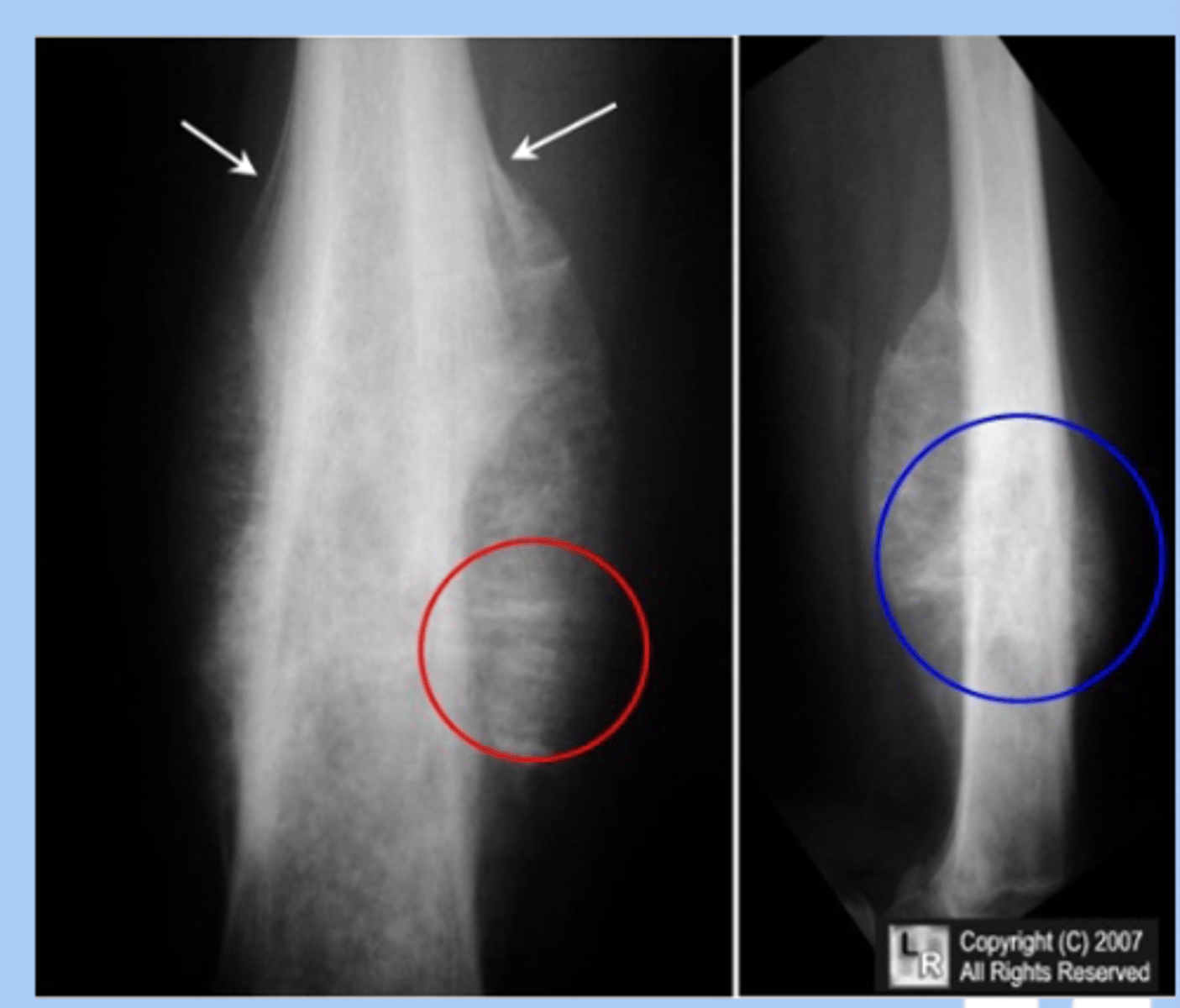 <p>-rare malignany presents as undifferentiated primary bone tumor </p><p>-sx: pain and tenderness, fever, leukocyotis </p><p>-dx: Xray= onion skin layering </p><p>-tx: chemo, radiation, surgery </p>