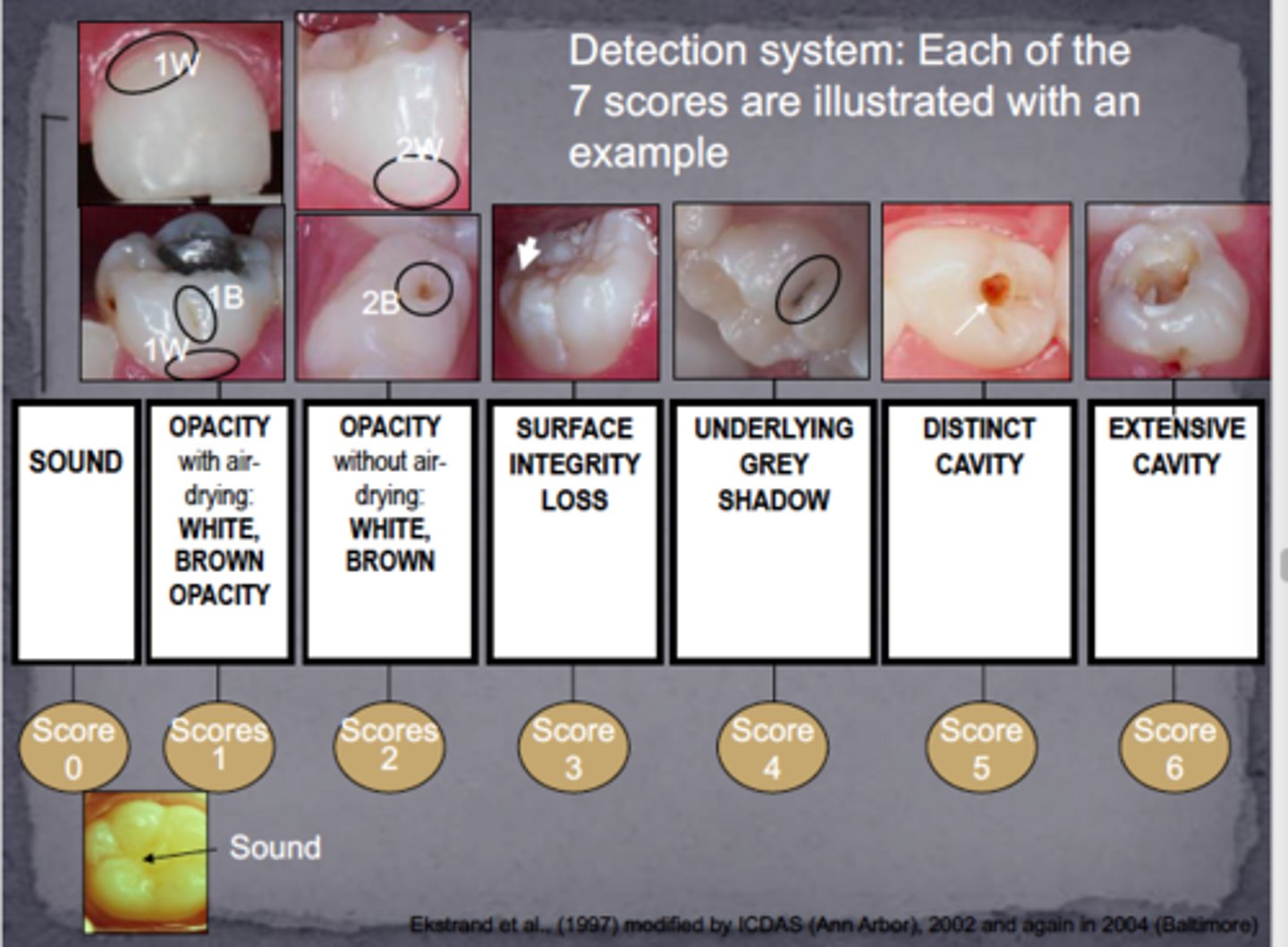 <p>0. Sound enamel<br>1. White/brown, <b>confined to fissure</b> (80% outer enamel, 10% dentin)<br>2. White/brown, <b>beyond fissure</b> (no loss of surface integrity, 50% inner enamel and 50% into outer 1/3 of dentin)<br>3. <b>Microcavitation</b> of enamel (lesion depth 77% in dentin)<br>4. <b>Shadow</b> of dentin (intact walls and ridges) (lesion depth 88% into dentin)<br>5. Distinct <b>cavitation</b> w/ exposed dentin (less than 1/2 tooth structure, 100% in dentin)<br>6. <b>Extensive cavitation</b> (100% in dentin, reaching inner 1/3)</p>
