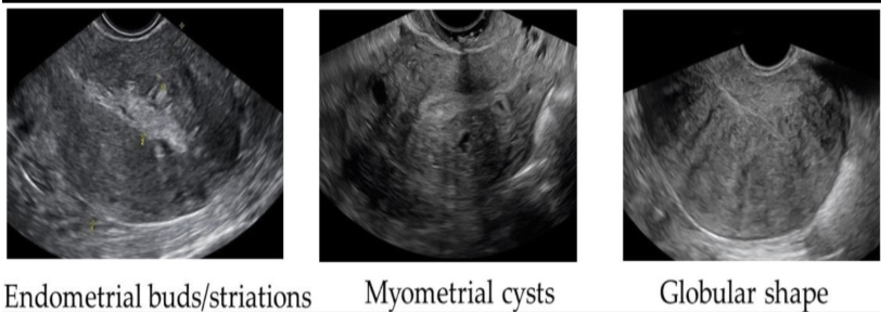 <p>the uteus is enlarged + shows multiple <strong>myometrial cysts </strong>&lt;6 mm in size + several subendometrial echogenic nodules. what is the most likely cause</p><p>a) endometrial atrophy</p><p>b) adenomyosis</p><p>c) endometrial carcinoma</p><p>d) endometrial abscess</p>