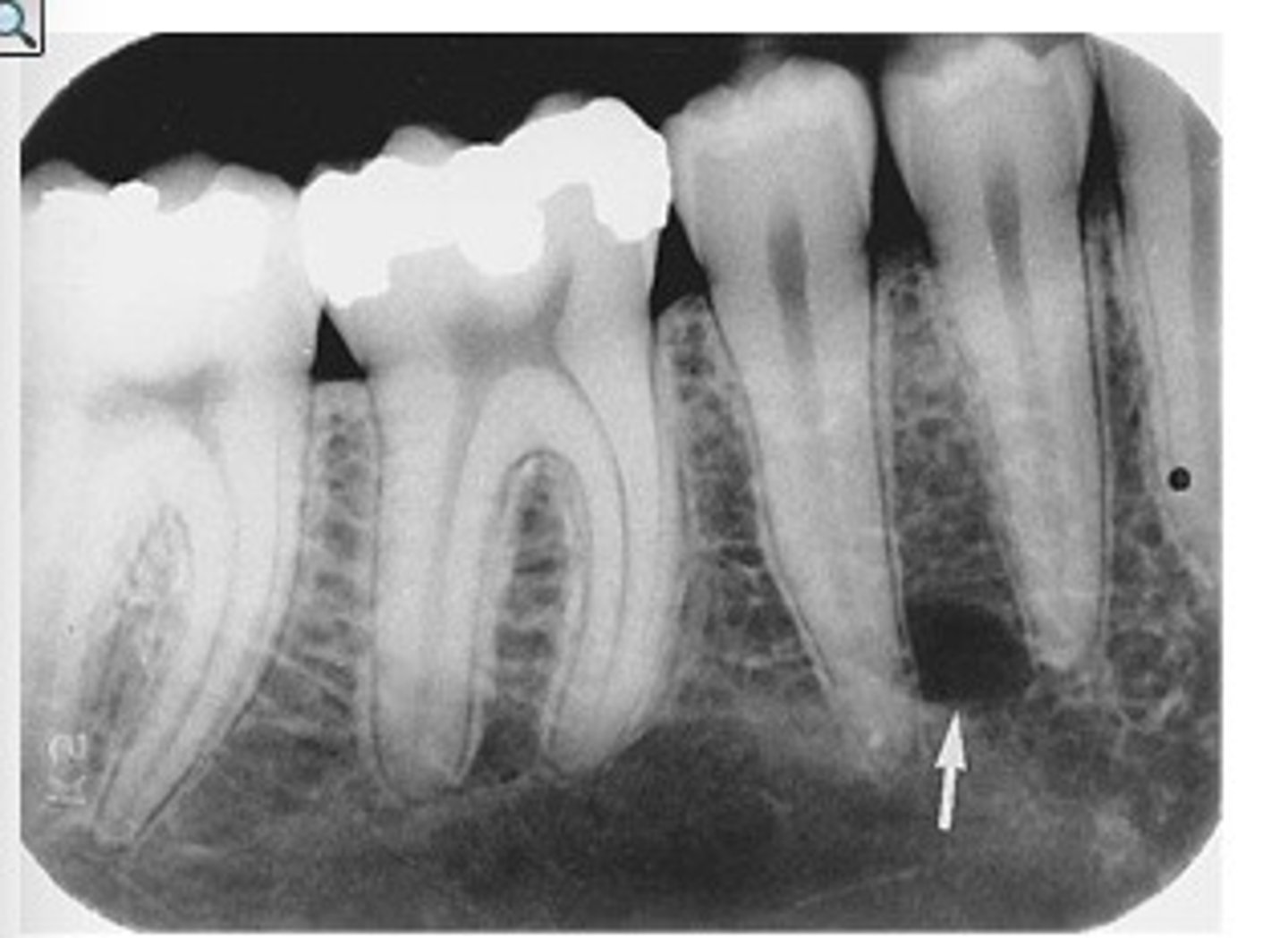 <p>area on x-ray film that appears black</p><p>• indicates less dense material</p><p>• x-ray beams pass easily through</p>