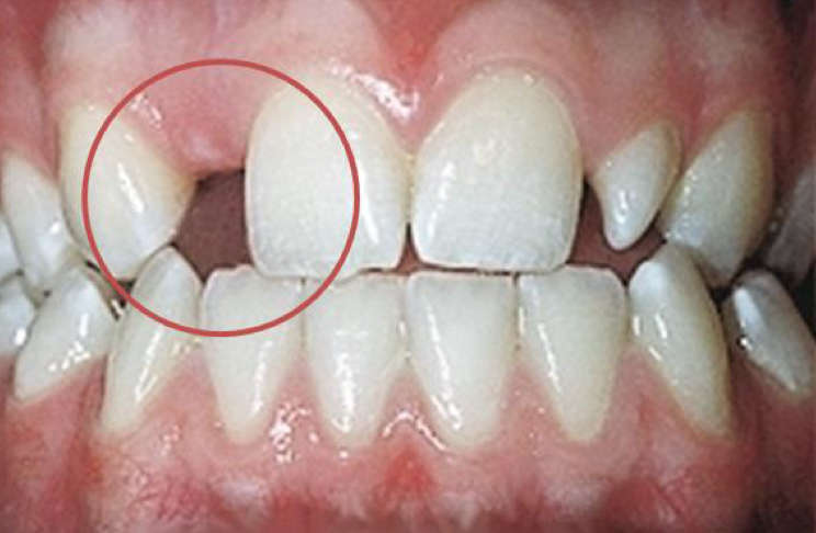 <p>One or more teeth fail to erupt/develop</p><p>High heritability</p><p>Rarely caused by mutation </p><p>Other teeth have smaller md dimension </p><p>Peg shaped or lateral conical- can skip generations </p>