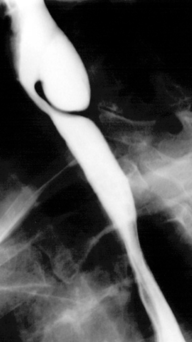 <p>abnormal "pouch", food can get caught causing dysphagia</p>