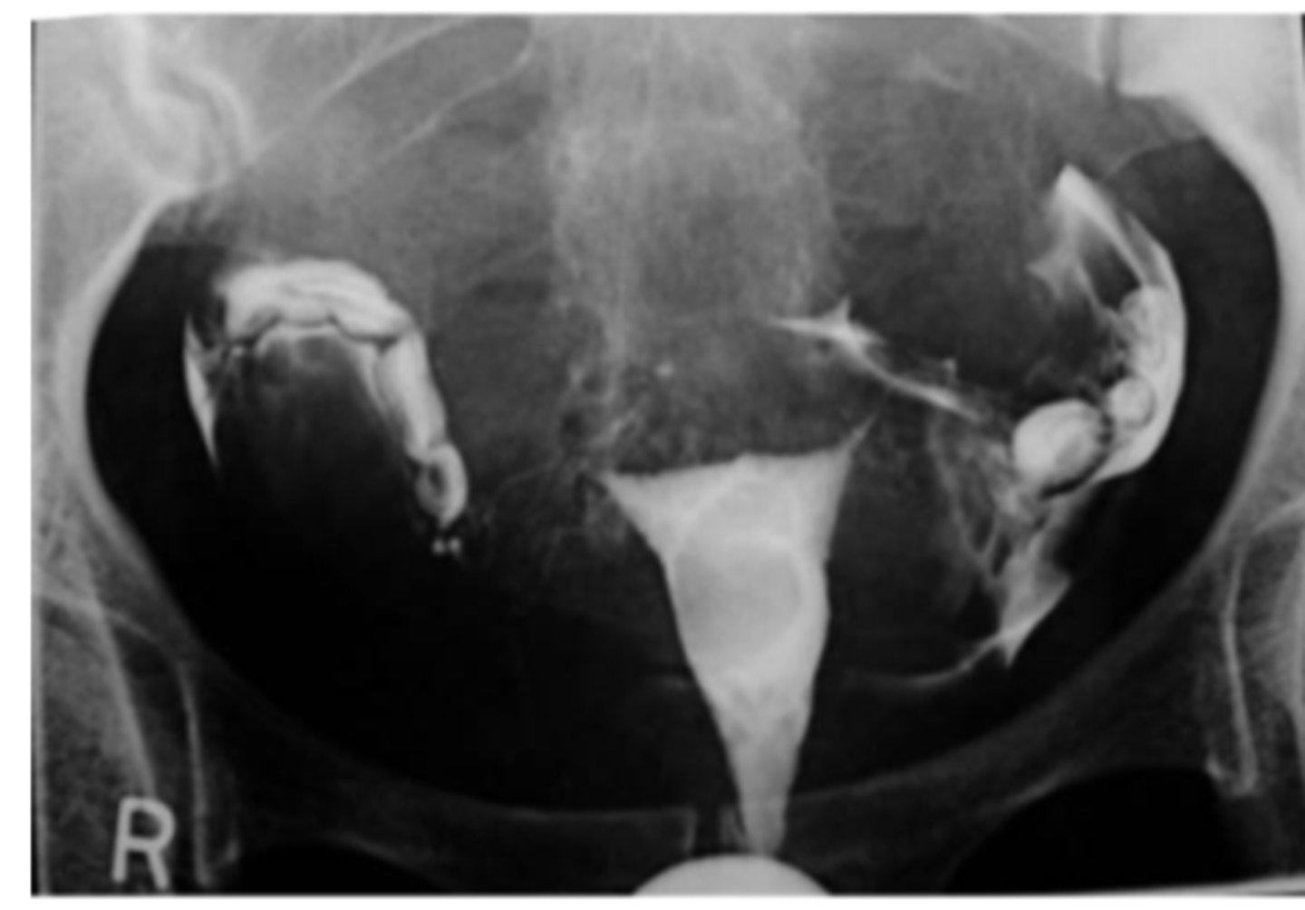 <p>X-ray procedure to investigate fallopian tube patency</p>