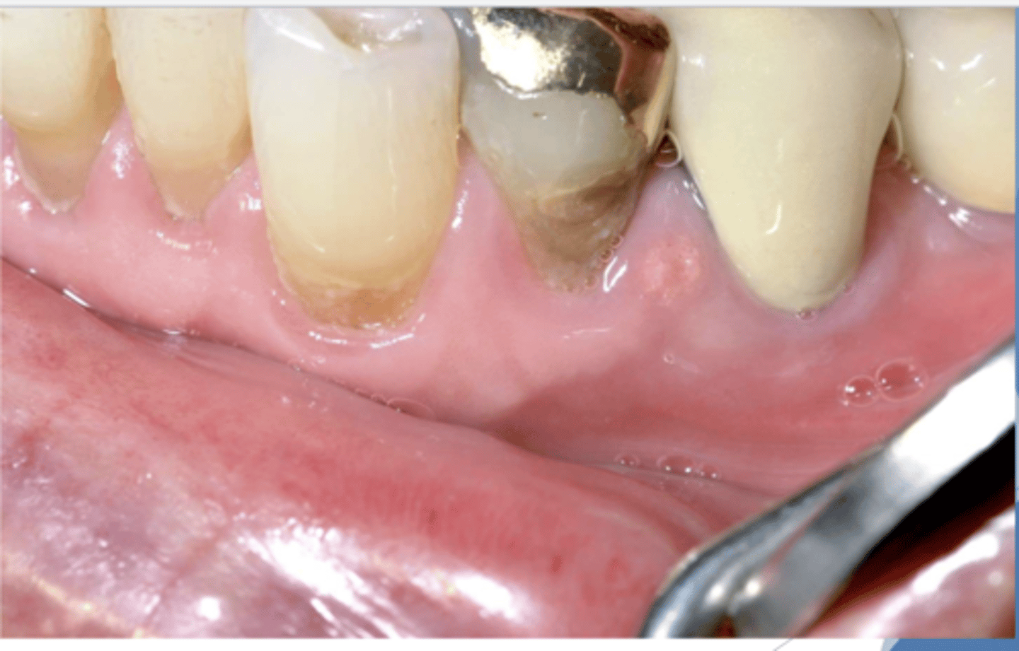 <p>Find the lesion. What diagnosis differential would you consider?</p>