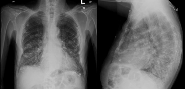 <p>Asbestosis (type of pneumoconiosis)</p>