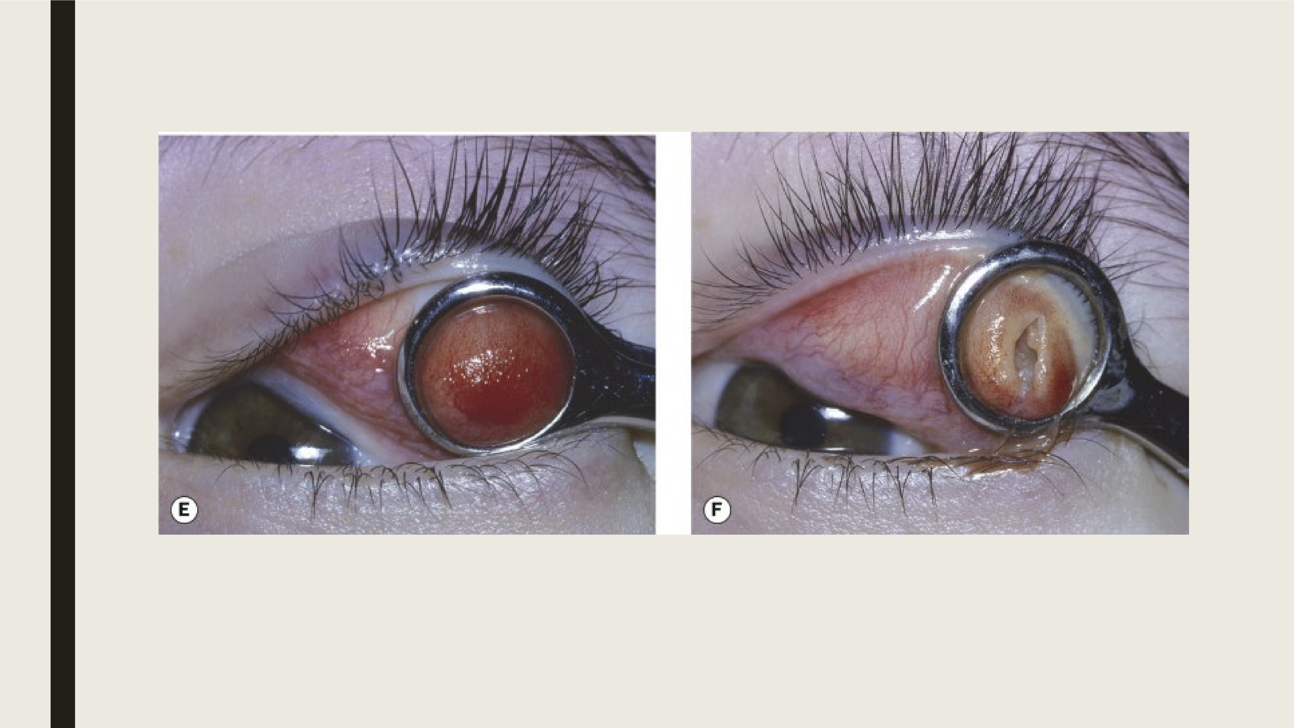 <ul><li><p>Monitor: 33% spontaneous resolve </p></li><li><p>Surgery: lesion is incised and drained</p></li><li><p>Injection: steroid injected into lesion (can thin skin and change color) </p></li><li><p>Oral antibiotics may be used for prophylaxis</p></li></ul><p></p>
