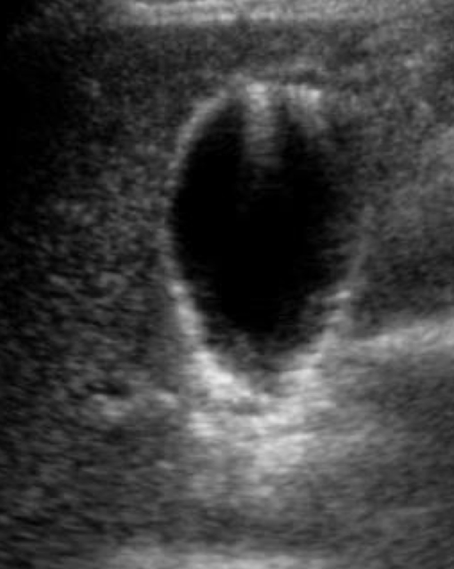 <p>hyperechoic shadow with tapering “tail”</p><p></p>