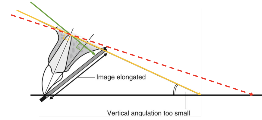 <p><strong>Elongation</strong><span>&nbsp;occurs, causing the teeth to appear&nbsp;</span><strong>longer</strong><span>&nbsp;than their true size</span></p>