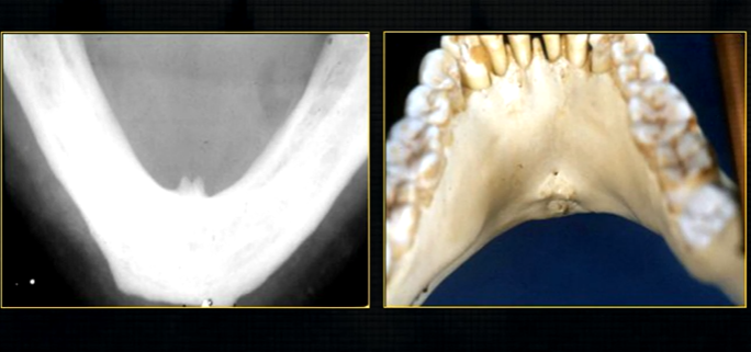 <p>lower occlusal </p>