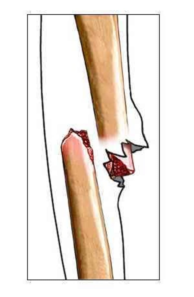 <p>A fracture in which the bone is broken and there is an open wound in the skin.</p>