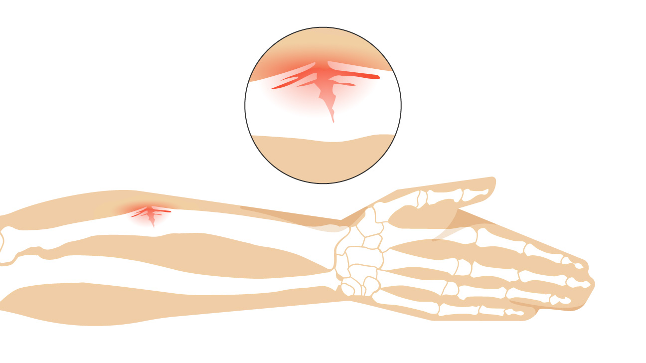<p>Bone only breaks on one side</p><ul><li><p>COMMON IN KIDS (10 &amp; under)</p></li></ul><p></p>